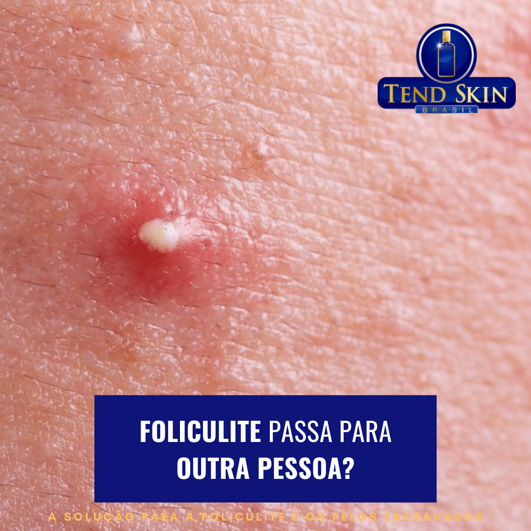 foliculite é contagiosa?