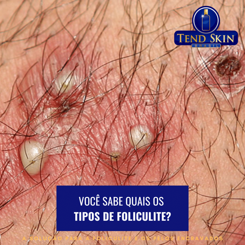 tipos de foliculite