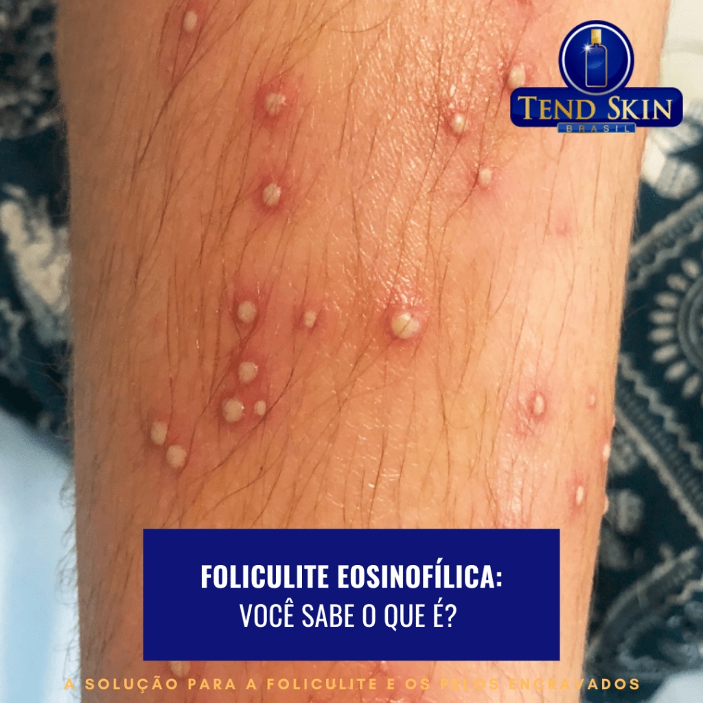 Foliculite Eosinofílica