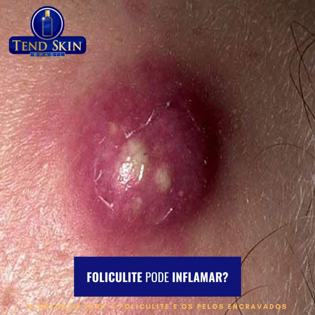 Foliculite pode inflamar