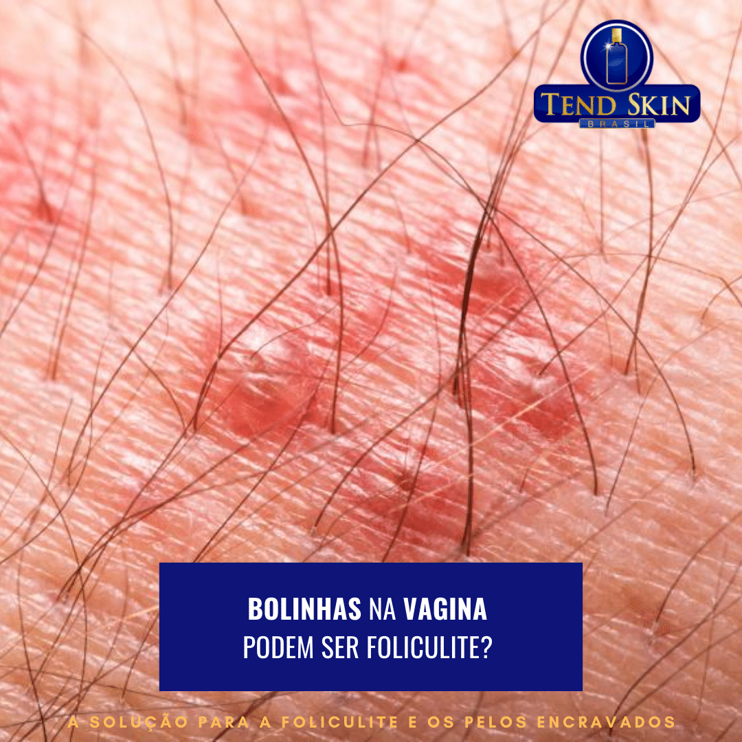 Bolinhas na vagina podem ser foliculite