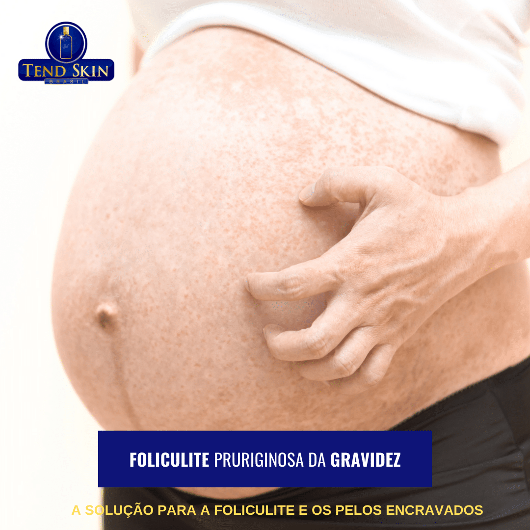 Foliculite pruriginosa da gravidez