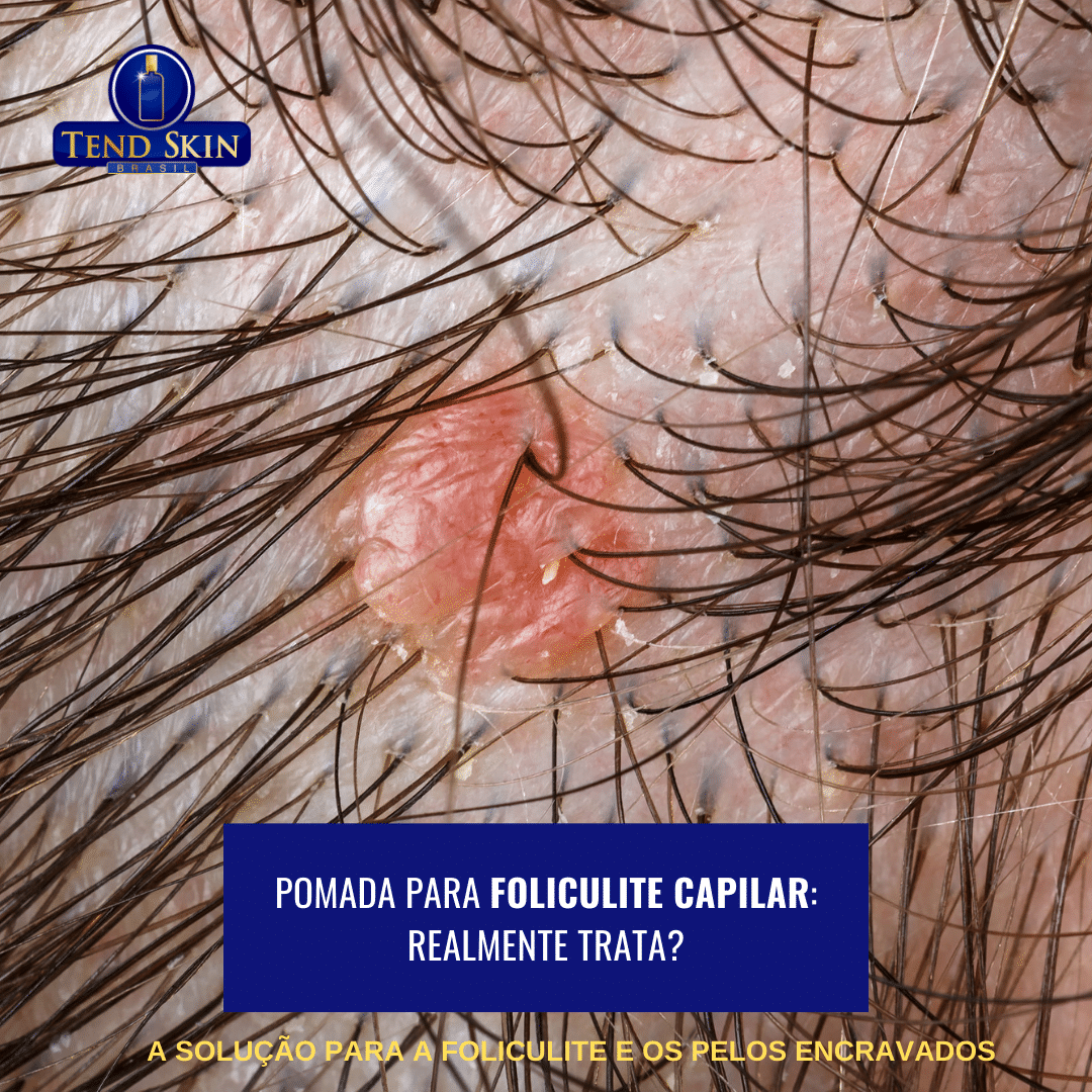 Remédio para foliculite capilar