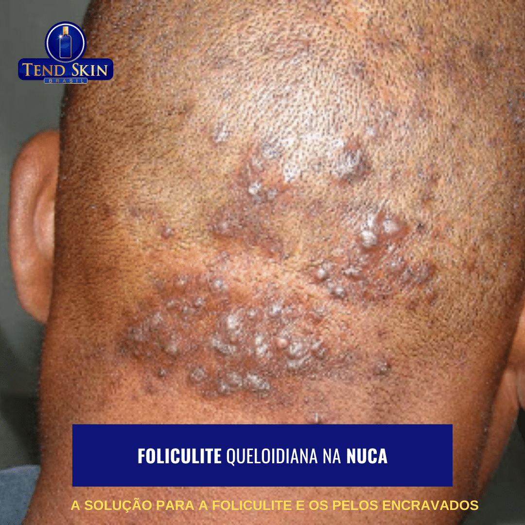 foliculite queloidiana na nuca