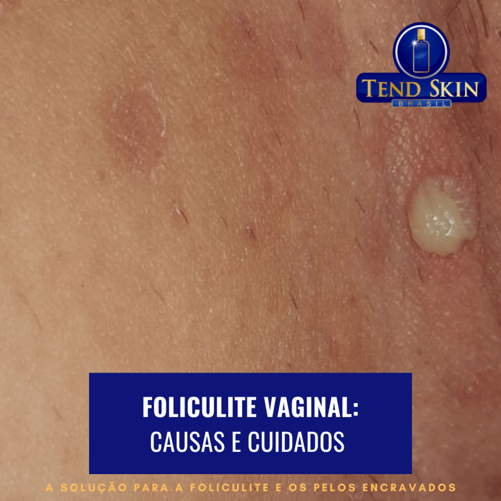 foliculite vaginal