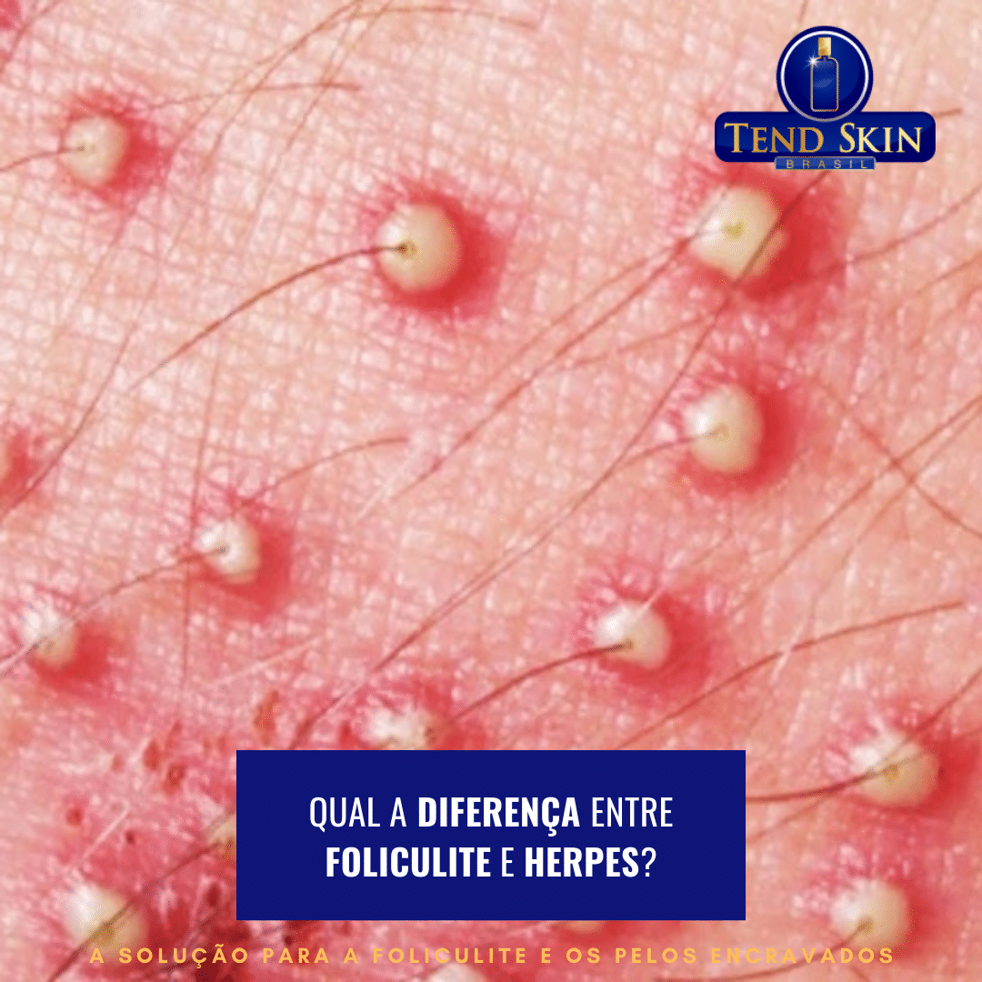 foliculite ou herpes