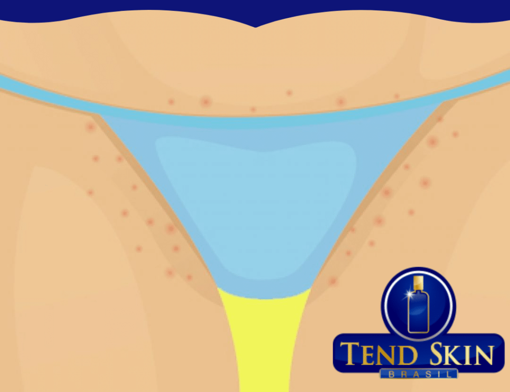 Pomada para foliculite