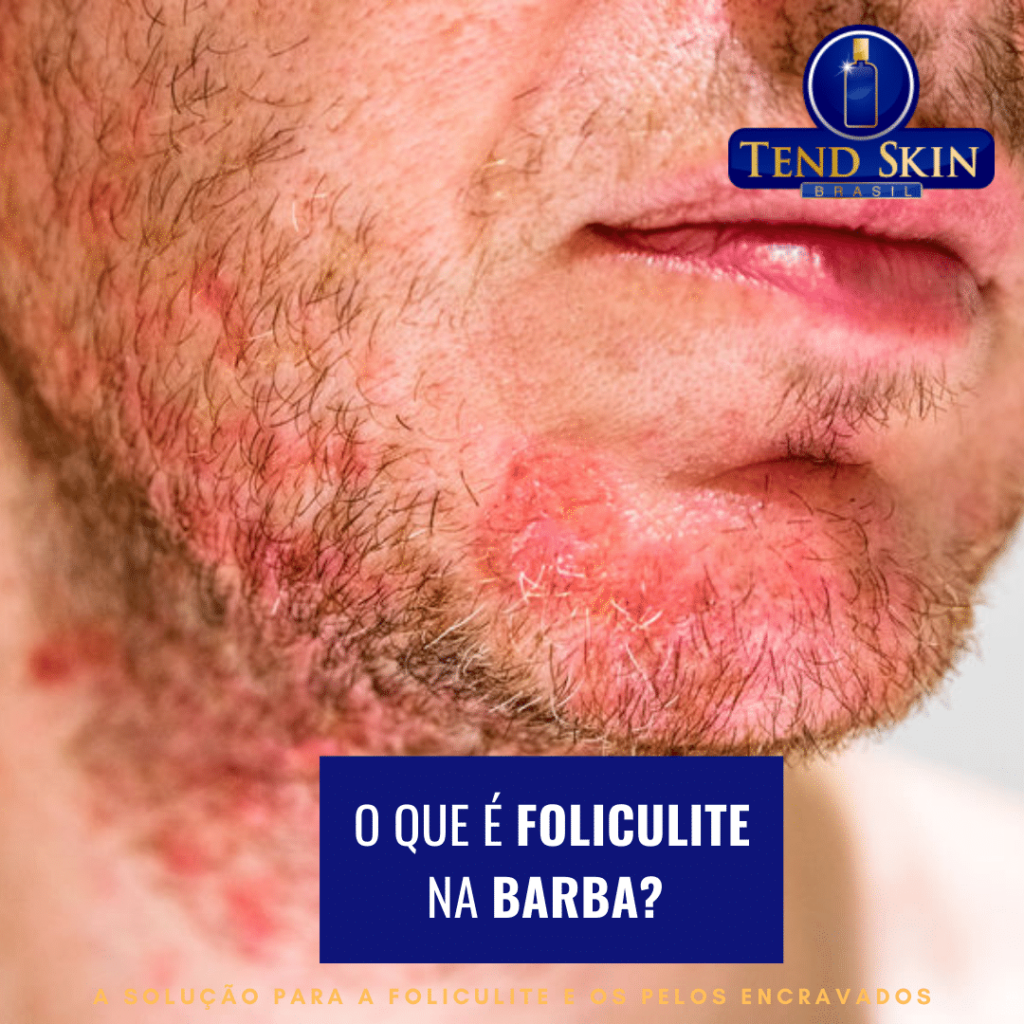 foliculite na barba