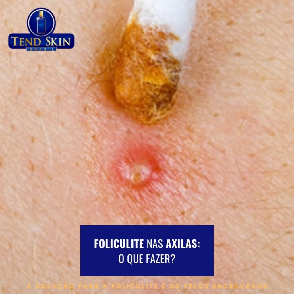 foliculite na axila